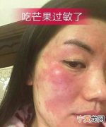 吃芒果过敏怎么办