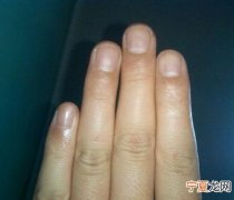指甲没月牙是不健康吗 指甲没月牙是不健康吗吗