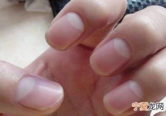 手指甲没有月牙是怎么回事吃什么药 手指甲没有月牙是怎么回事
