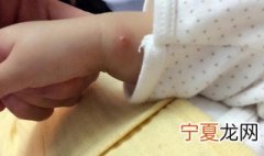 蚊虫叮咬红肿用什么药快速消肿止痒 蚊虫叮咬红肿用东西药快速消肿止痒