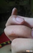 水泡破了怎么办