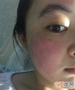 脸过敏发红怎么办