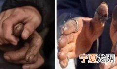 冬天手指开裂怎么办 冬天手指开裂有什么解决方法