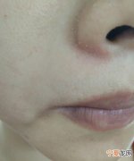 鼻子脱皮怎么办，鼻子脱皮怎么回事