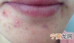 经常长痘痘如何调理 经常长痘痘怎么调理