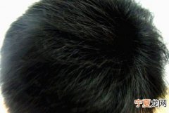 头皮屑多是什么原因怎么办 头皮屑多怎么办什么原因引起的啊