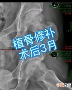 股骨头坏死吃什么好，股骨头坏死怎么治疗