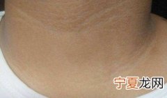 脖子上黑黑的像污垢怎么去除 小孩脖子上黑黑的像污垢怎么去除