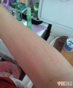 山药弄到手上很痒怎么办