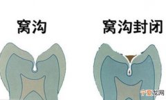 牙齿窝沟封闭多少钱 牙齿窝沟封闭多少钱一颗
