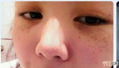 眼睛周围长斑怎么办