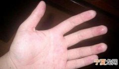 手心脚心发热怎么办，高烧手心、脚心发热怎么治疗？