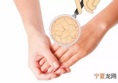 夏天手脱皮怎么回事 一到夏天手脱皮怎么回事