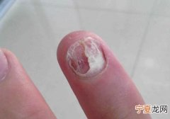 指甲脱落是什么原因 指甲脱落是什么原因引起的