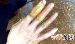 手被蒸汽烫伤怎么办 手被蒸汽烫伤如何处理