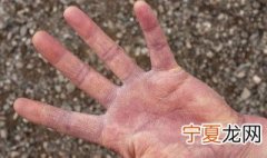 冬天手脱皮怎么办 有什么好的改善办法