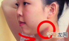 草莓印最快消除的方法 草莓印最快消除的方法介绍