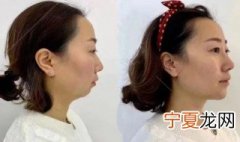 玻尿酸丰下巴多久才软 玻尿酸丰下巴多久恢复自然