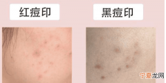 有黑色痘印怎么护肤