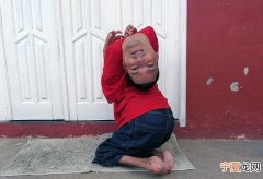 arthrogryposis 巴西“倒头男”天生患关节拘缩症